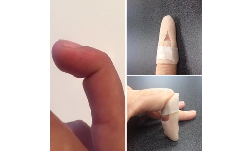 Fingertip Won't Straighten? It Could Be Mallet Finger